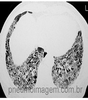 NOVAS DROGAS PROMISSORAS EM FIBROSE PULMONAR IDIOP�TICA